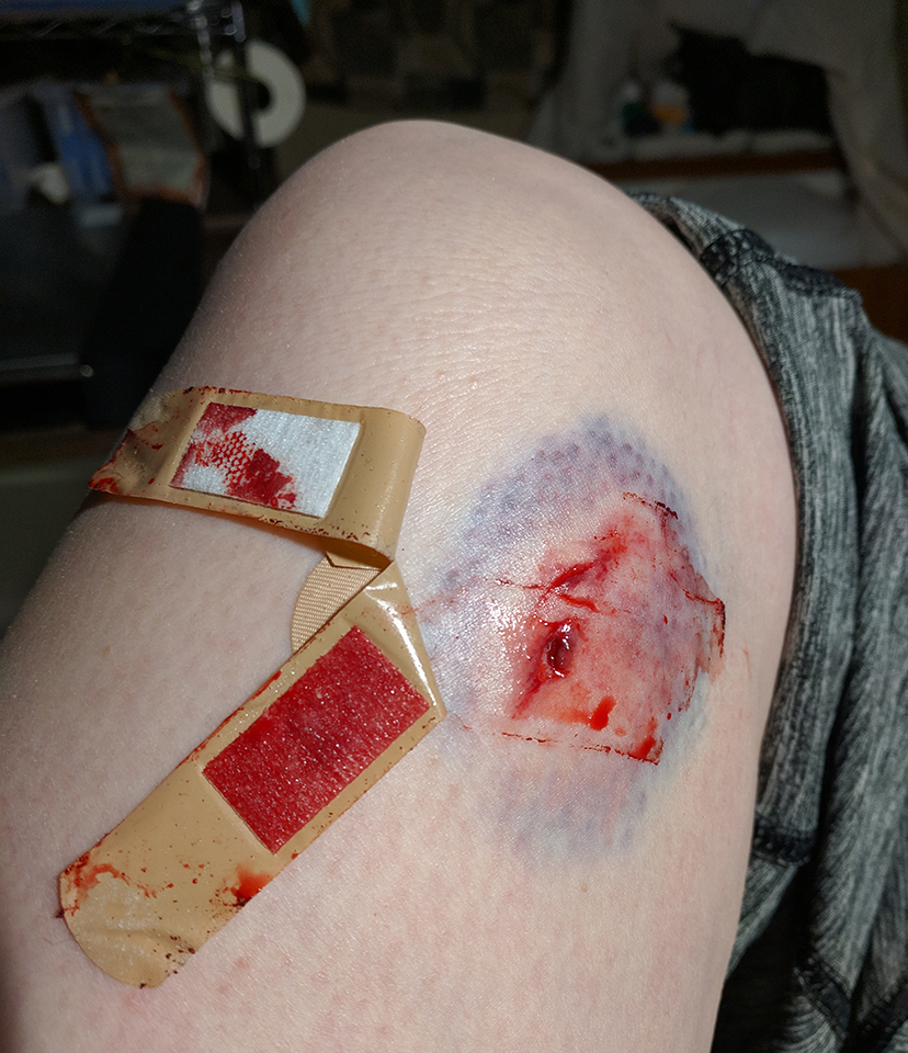 Bleeding wound with bloody bandaids